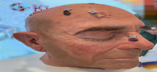Ist das Hautkrebs? Das ist hier die Frage Ist das Hautkrebs? Das ist hier die Frage